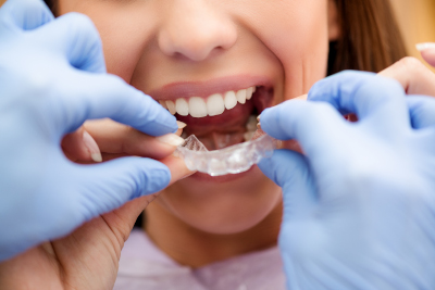 dentiste montrant goutiere invisalign